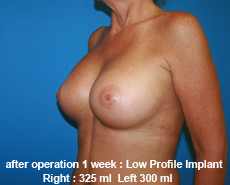 plastic-surgery-breast-augmentation